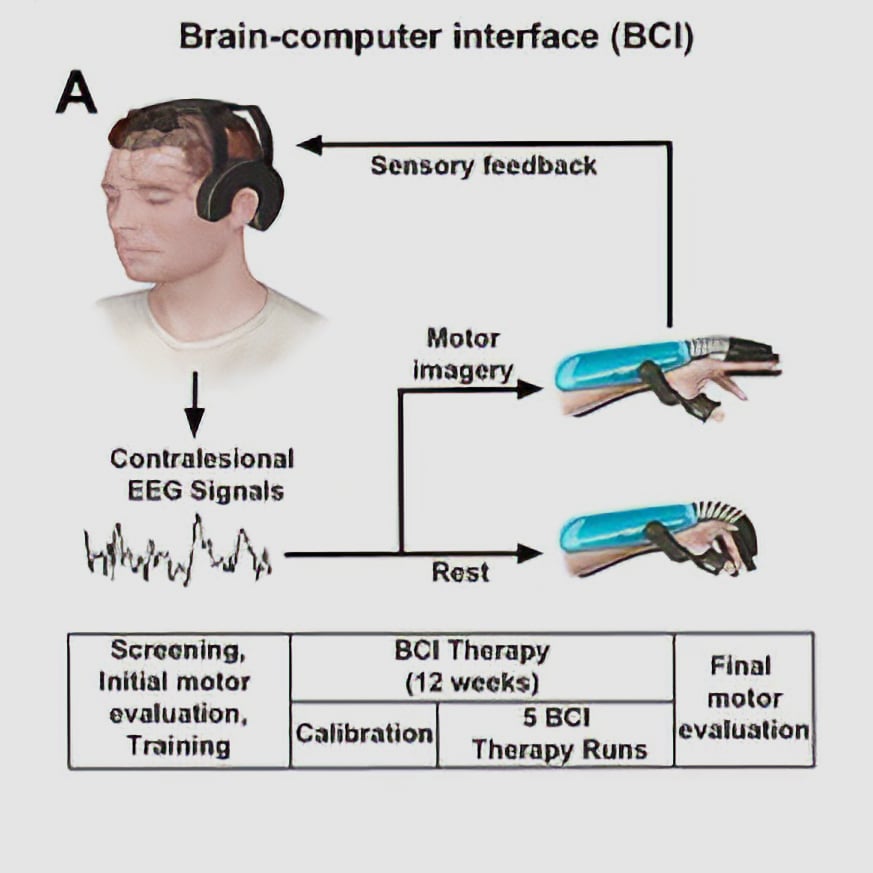 Diagram of a brain-computer interface (BCI) therapy system used by Kandu. A person wearing a headset generates brain signals (EEG) that control a hand device through motor imagery. The system provides sensory feedback to the user. The therapy process includes screening, calibration, multiple therapy sessions over 12 weeks, and a final motor evaluation.
