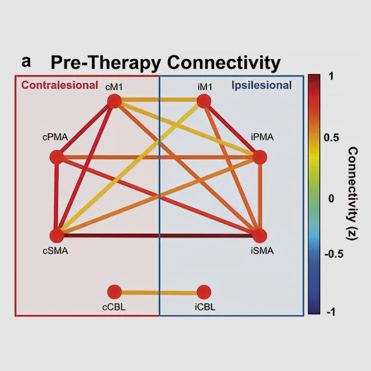 Diagram of brain network connectivity before therapy. Multiple motor-related regions across both hemispheres (contralesional and ipsilesional) are highly interconnected, with strong connections shown in warm colors indicating higher connectivity strength.